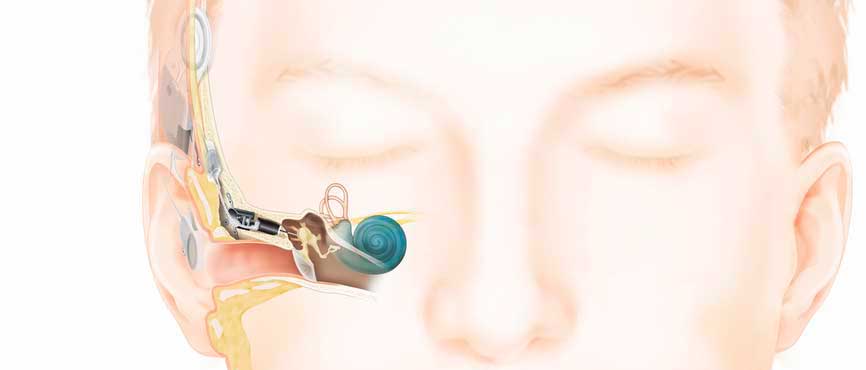 implante de oído medio Carina